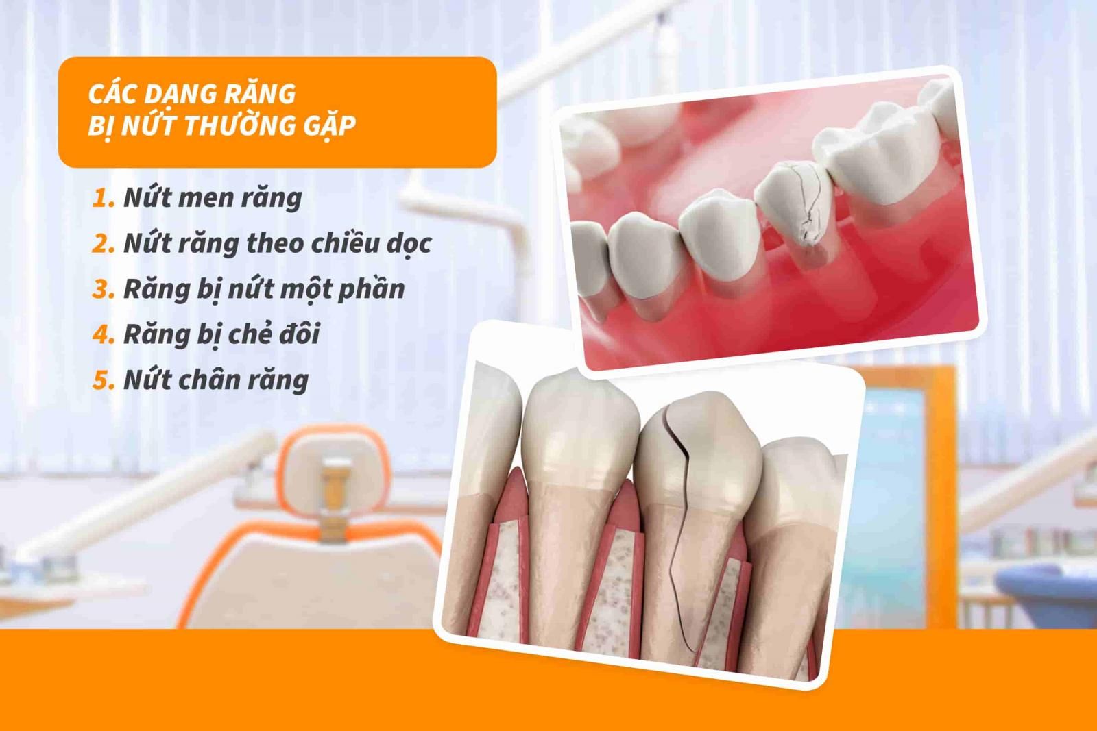 Các dạng răng bị nứt thường gặp