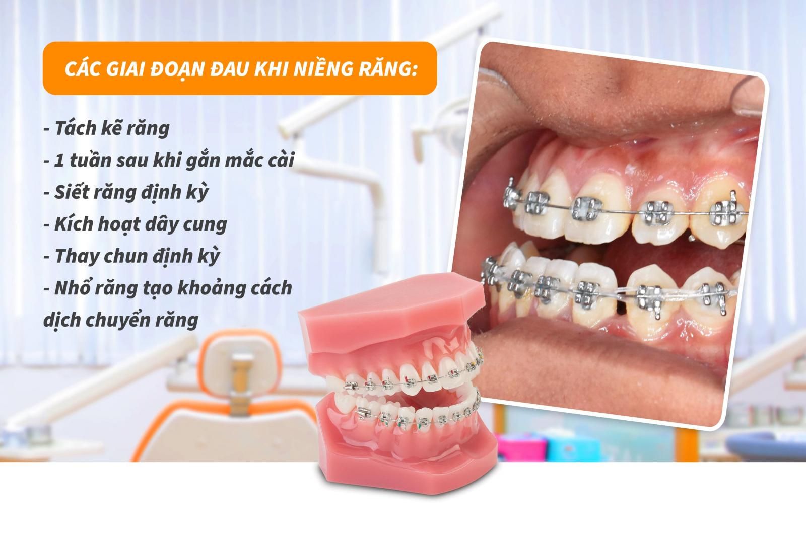 Các giai đoạn đau khi niềng răng