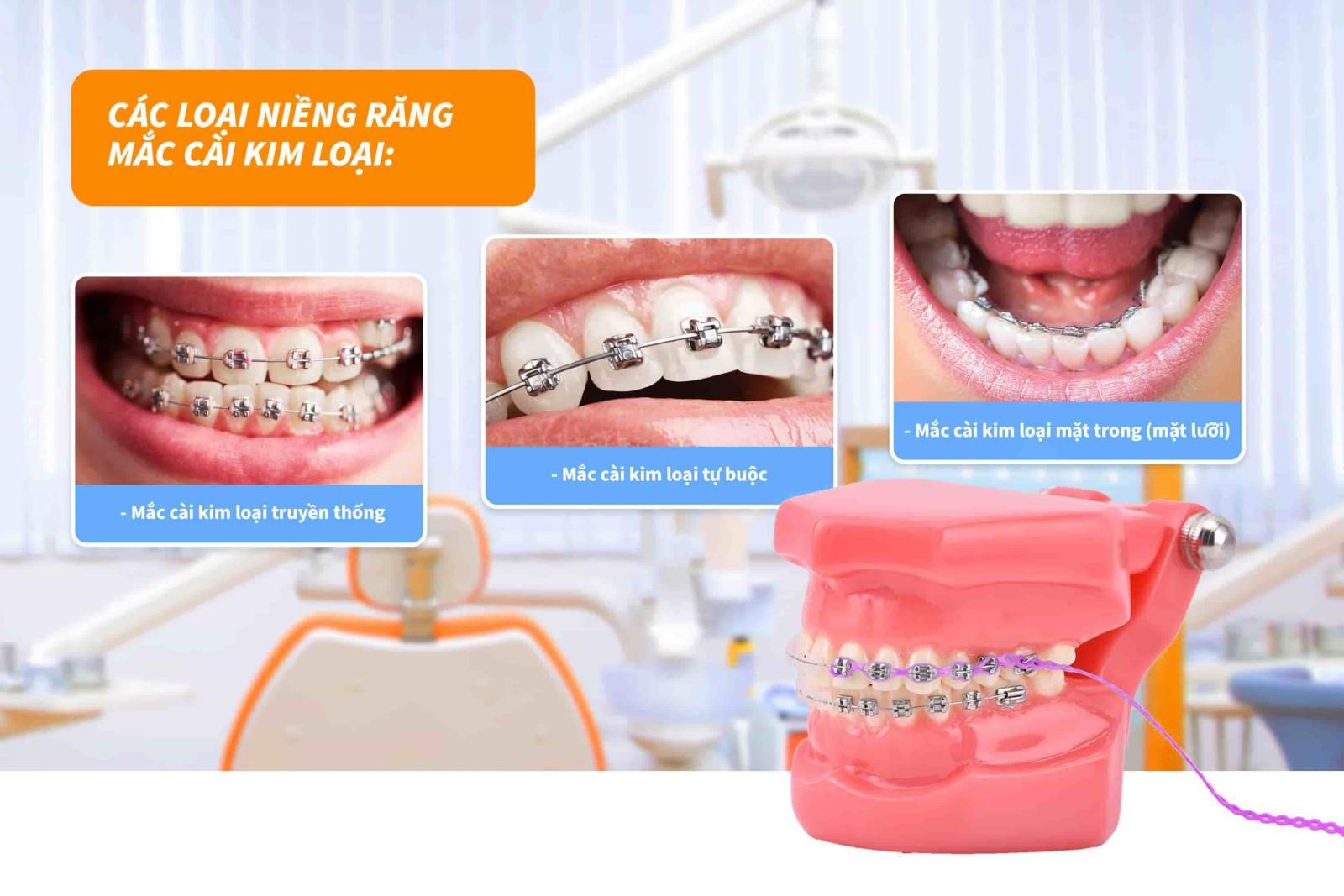 Các loại niềng răng mắc cài kim loại hiện nay