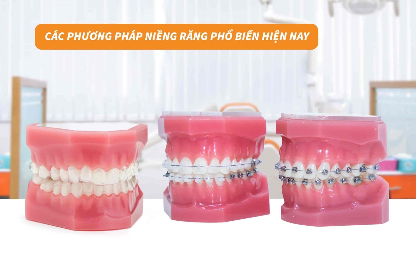 Các phương pháp niềng răng phổ biến hiện nay