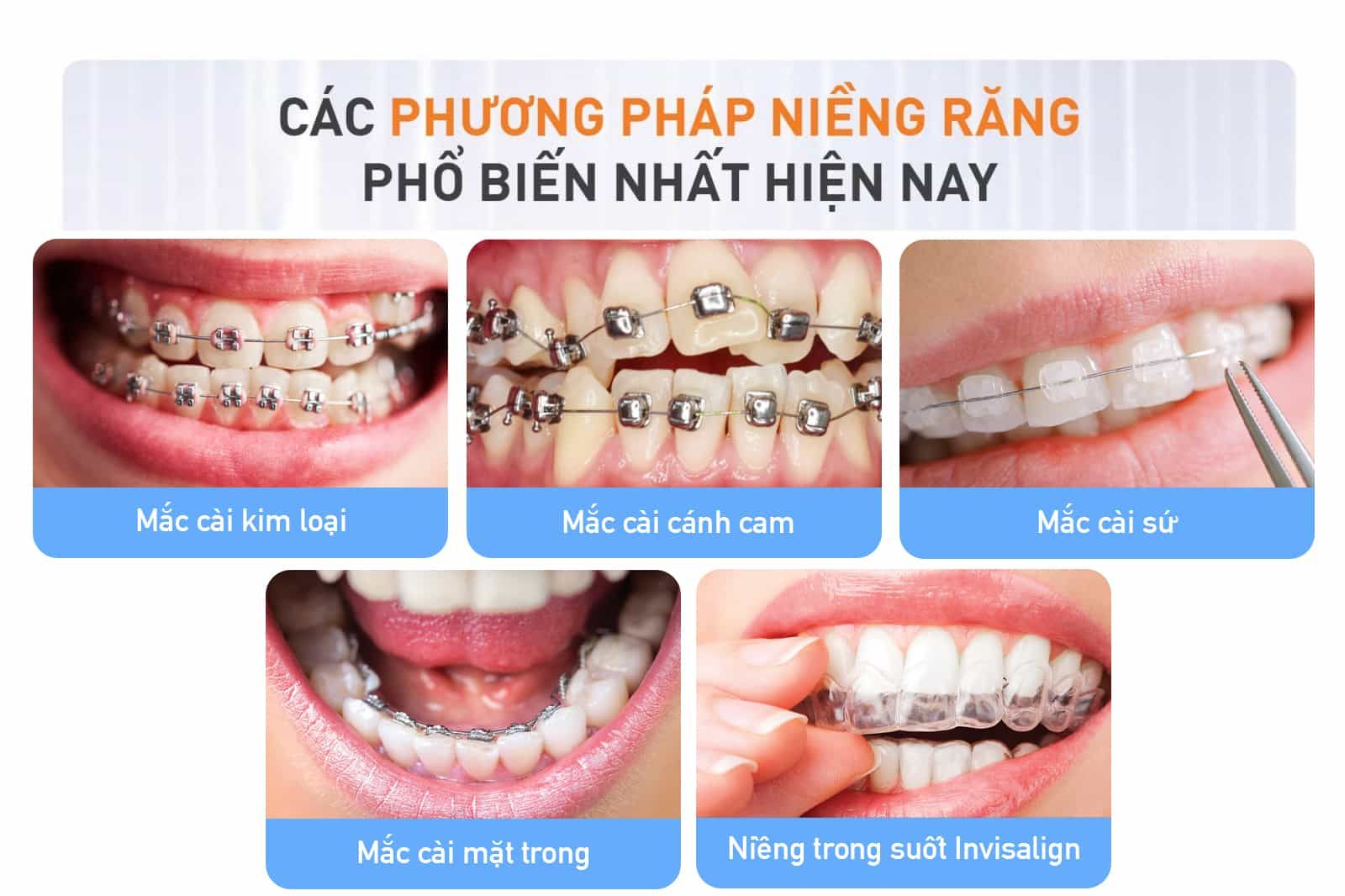 Các phương pháp niềng răng phổ biến hiện nay