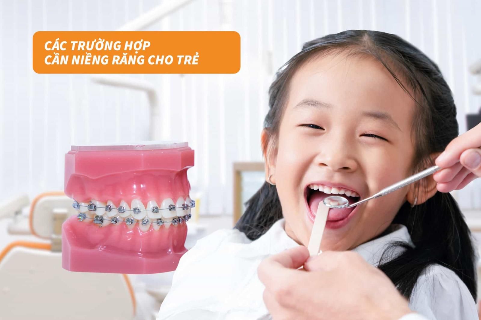 Các trường hợp cần niềng răng cho trẻ