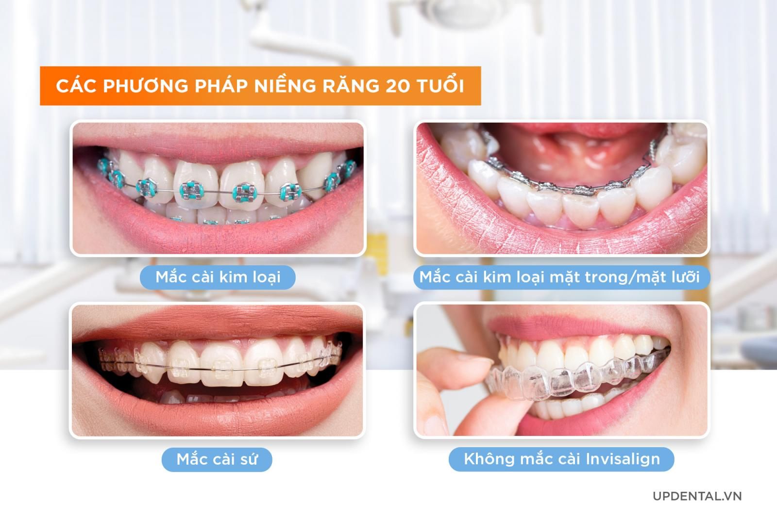 các phương pháp niềng răng tuổi 20