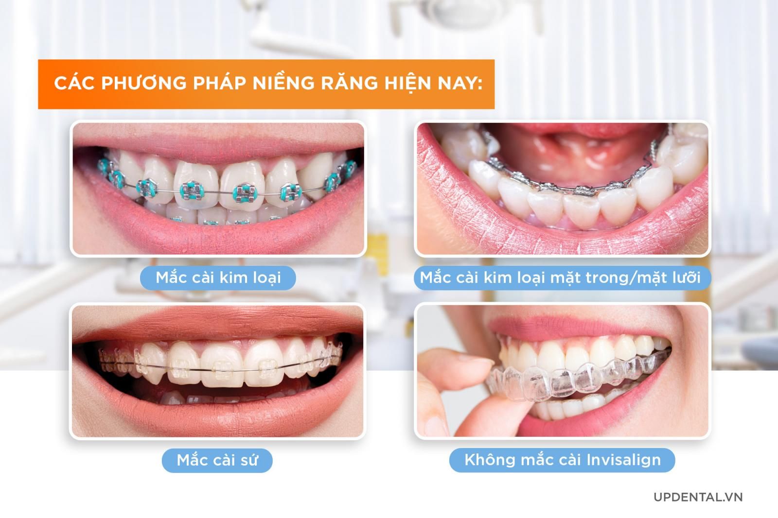 4 phương pháp niềng răng hiện nay