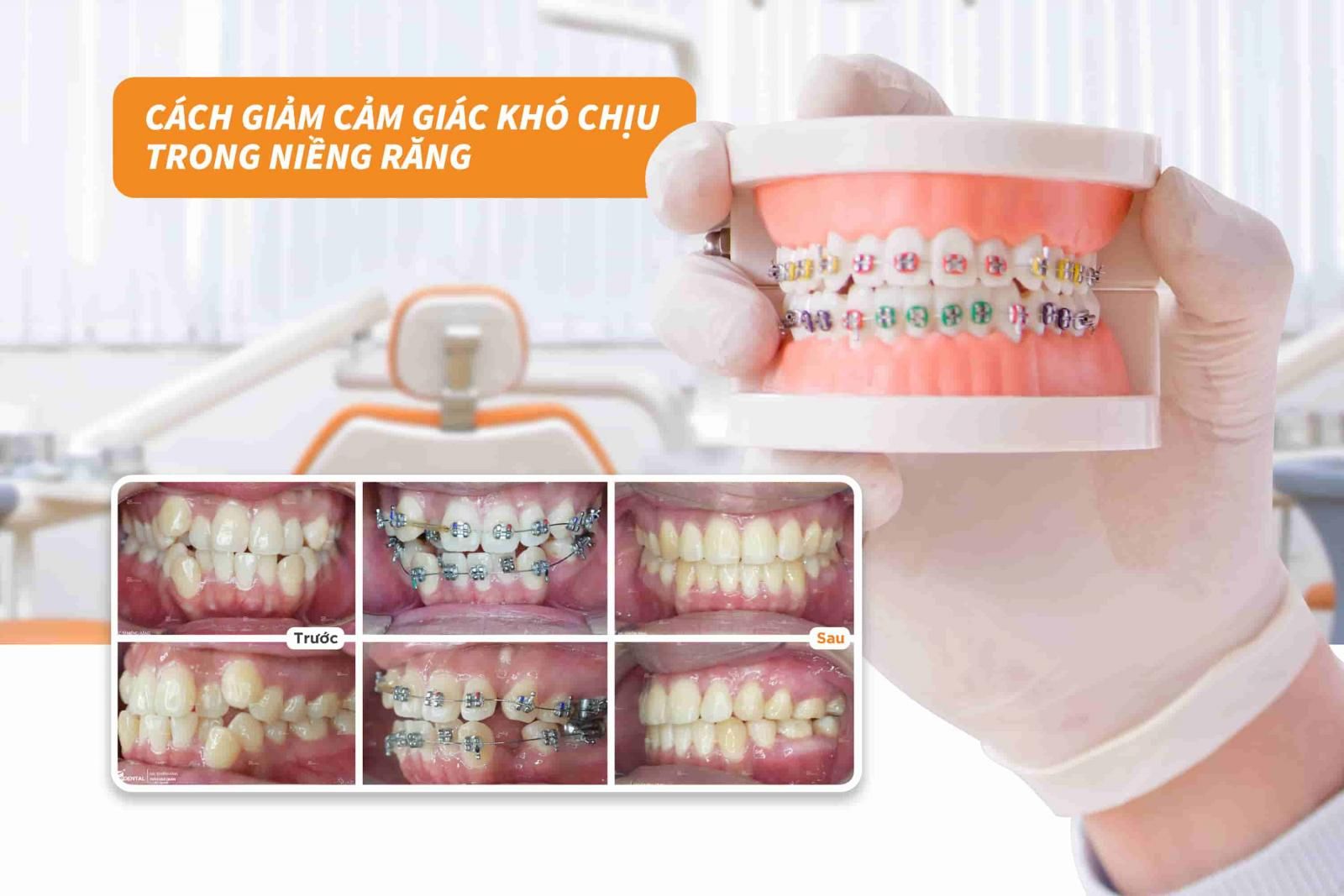 Cách giảm cảm giác khó chịu trong niềng răng