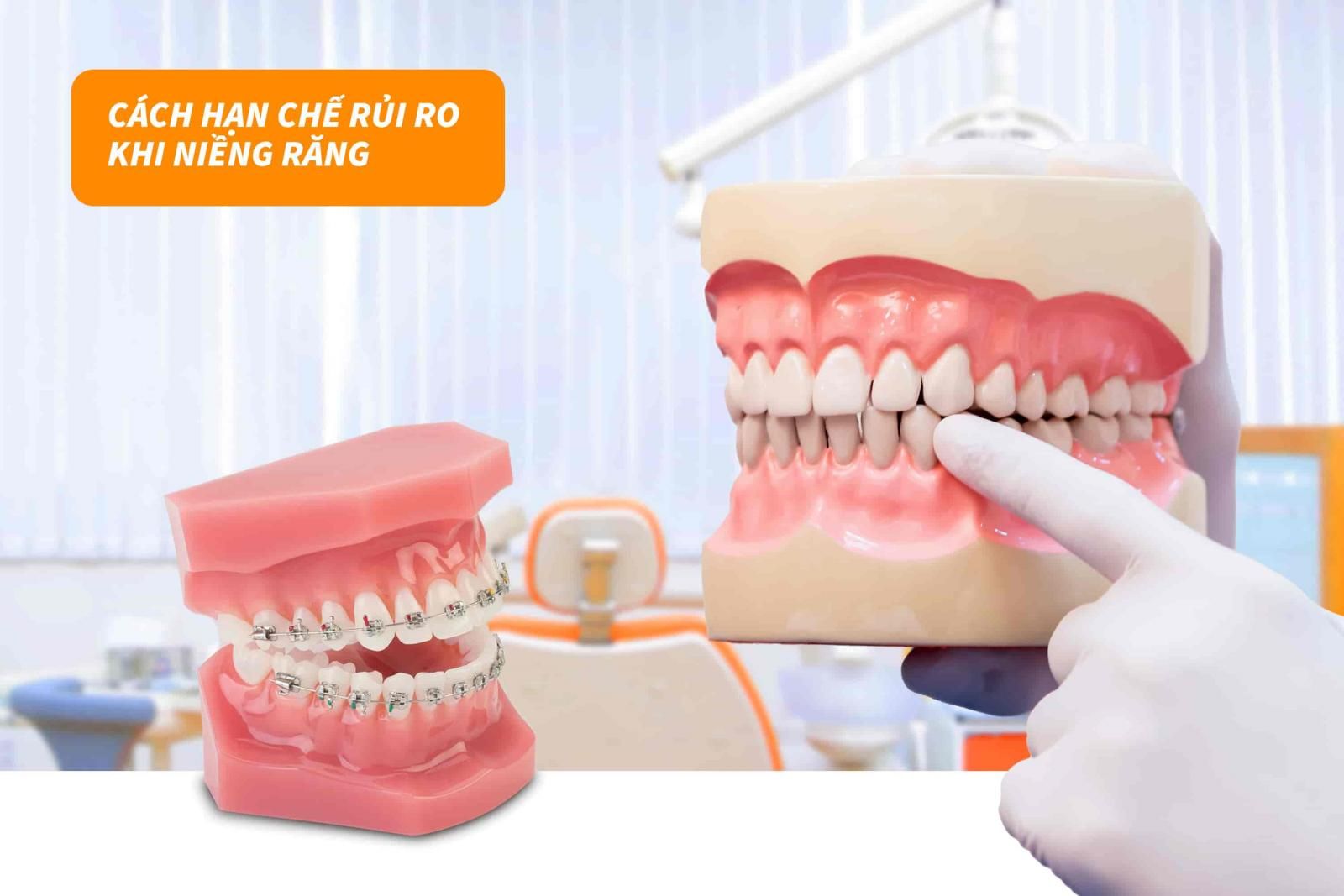 Cách hạn chế rủi ro khi niềng răng