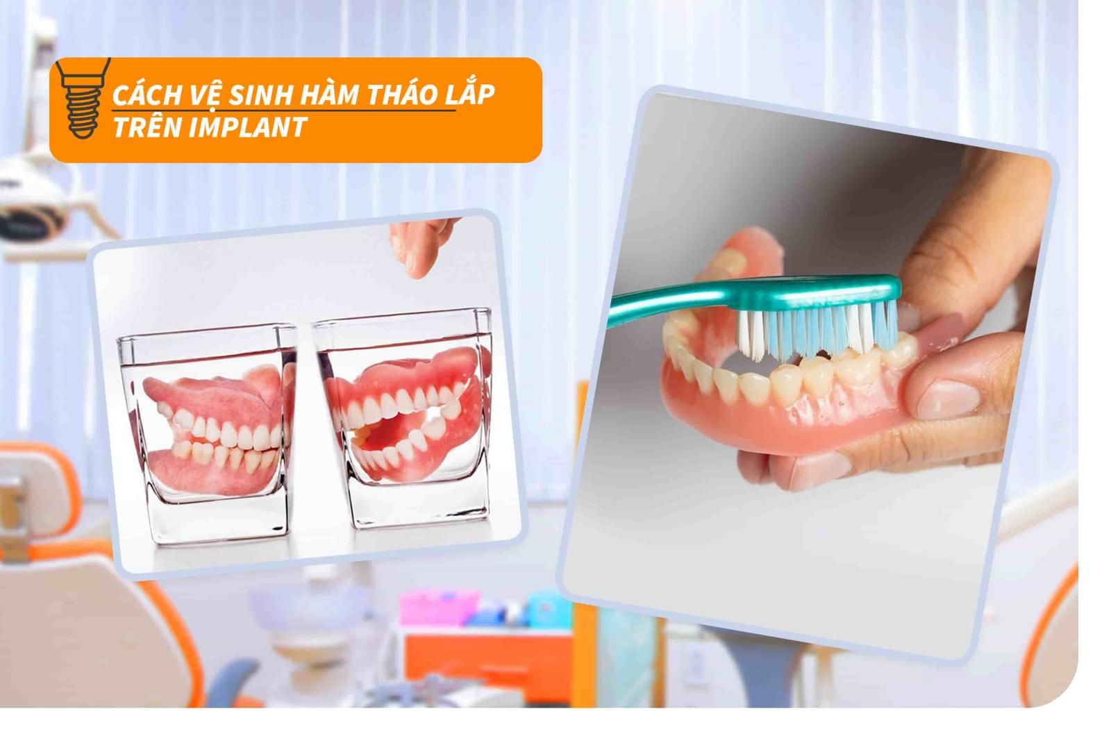 Cách vệ sinh hàm tháo lắp trên Implant