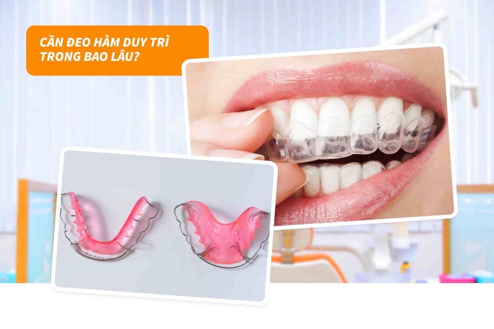 Cần đeo hàm duy trì trong bao lâu