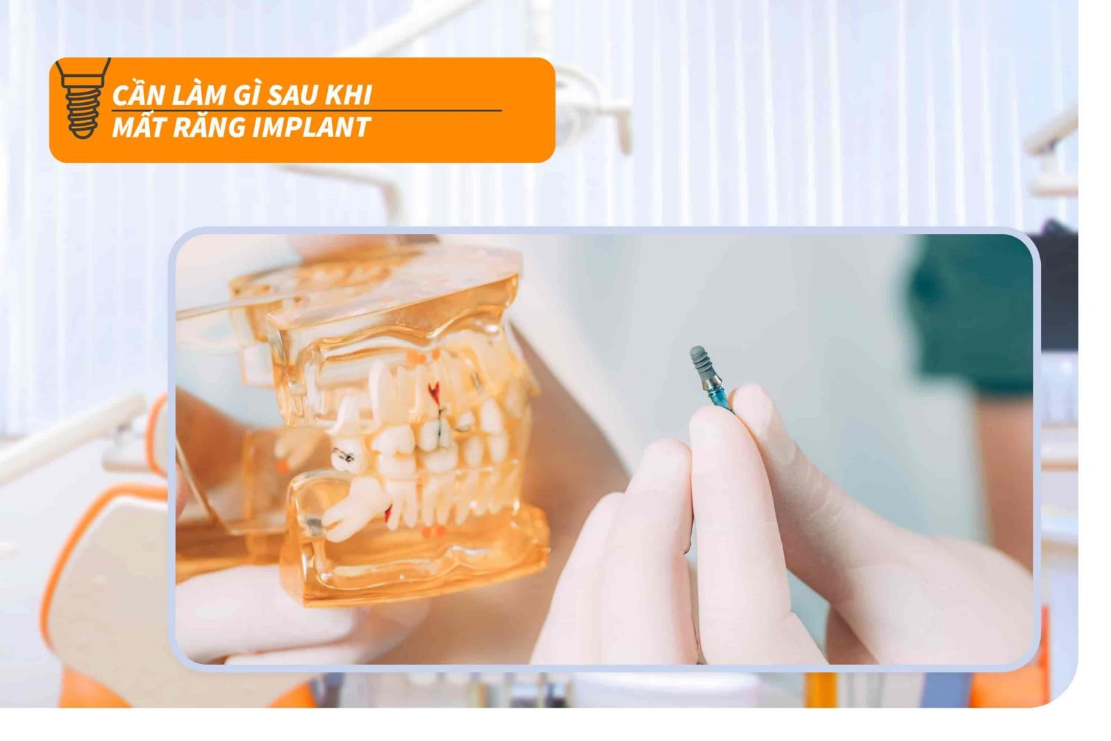 Cần làm gì sau khi mất răng Implant