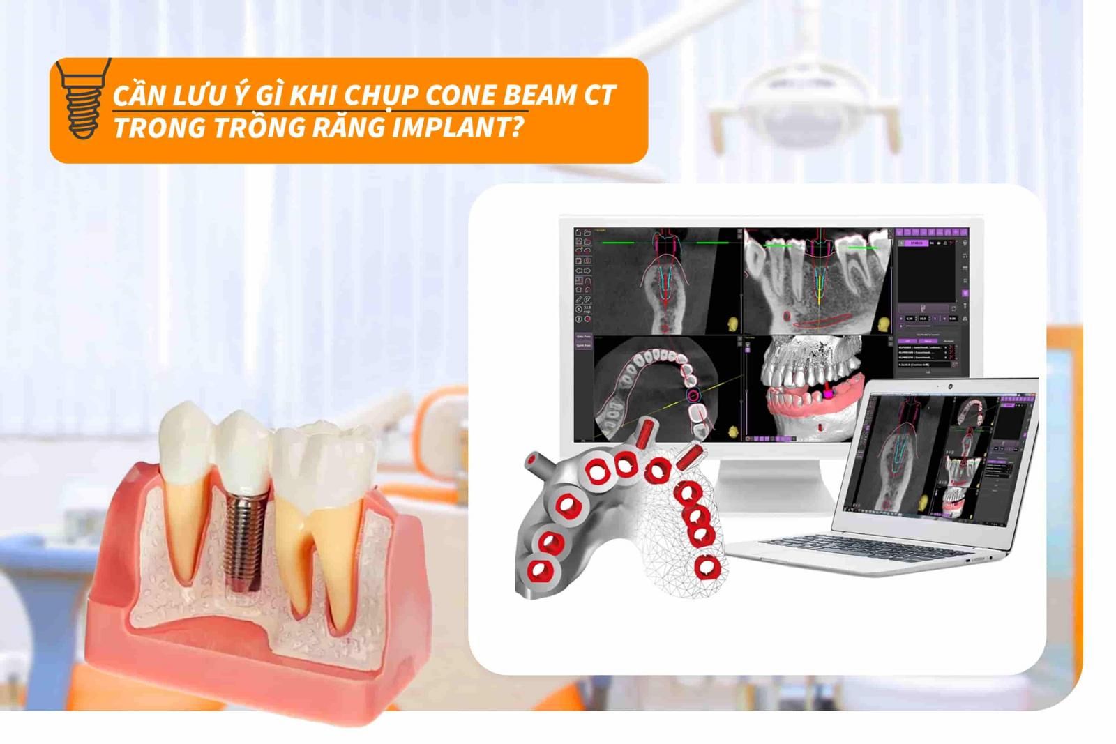 Lưu ý khi chụp phim Cone Beam CT trong trồng răng Implant