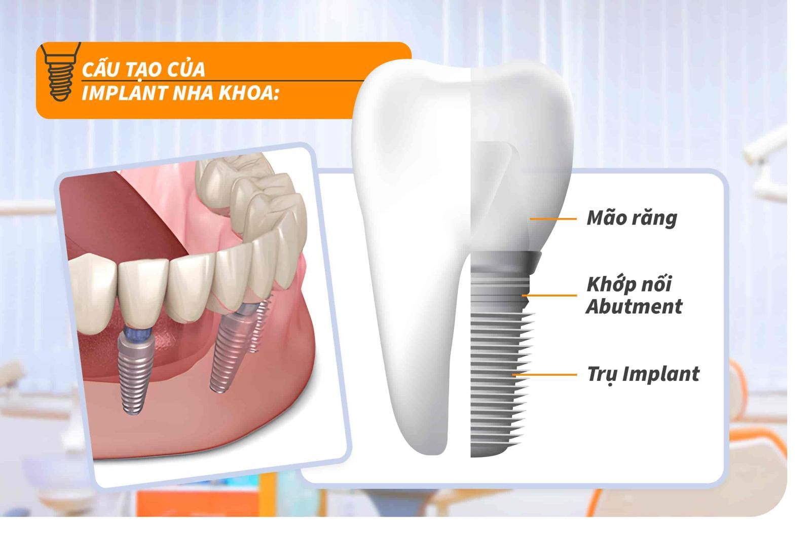 Cấu tạo của Implant nha khoa