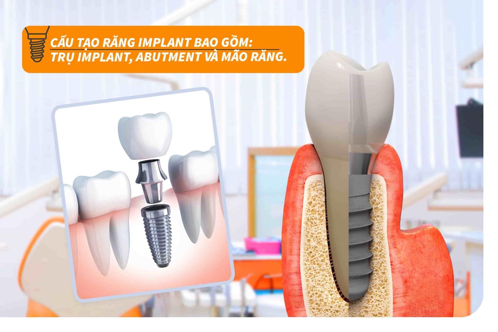 Cấu tạo của răng Implant