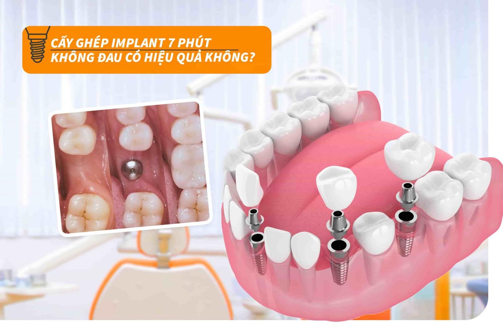 Cấy ghép Implant 7 phút không đau có hiệu quả không