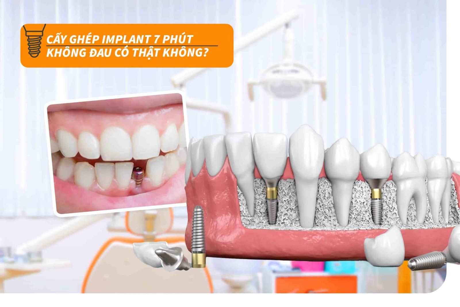 Cấy ghép Implant 7 phút không đau có thật không