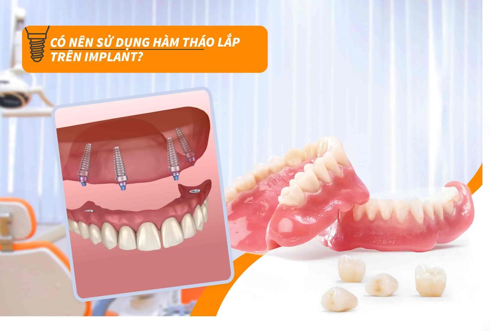 Có nên sử dụng hàm tháo lắp trên Implant