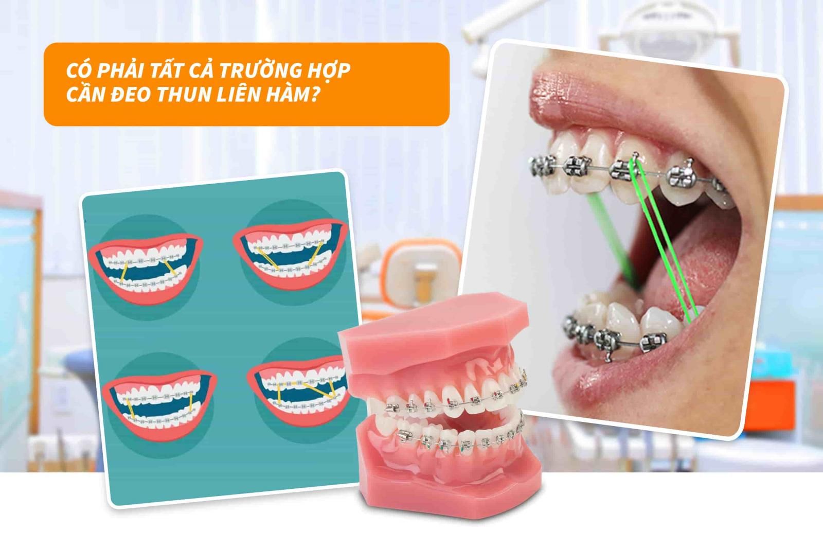 Có phải tất cả các trường hợp cần đeo thun liên hàm?