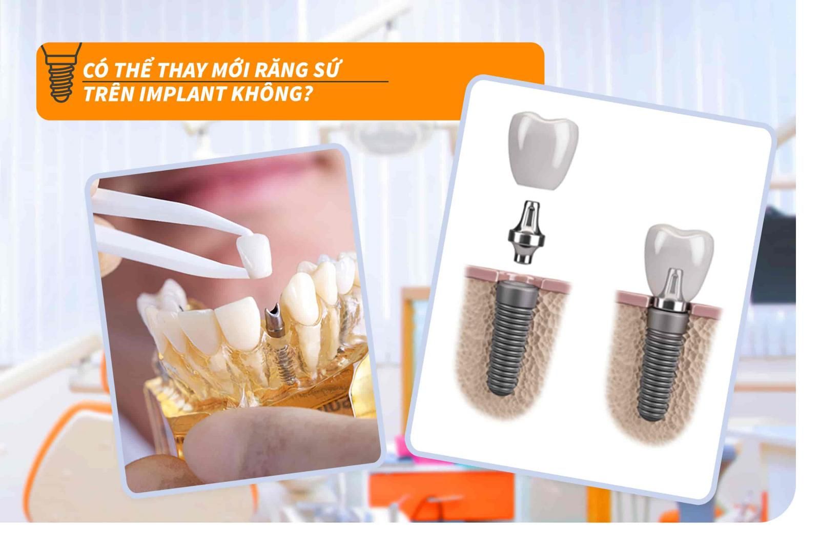 Có thể thay mới răng sứ trên Implant không?