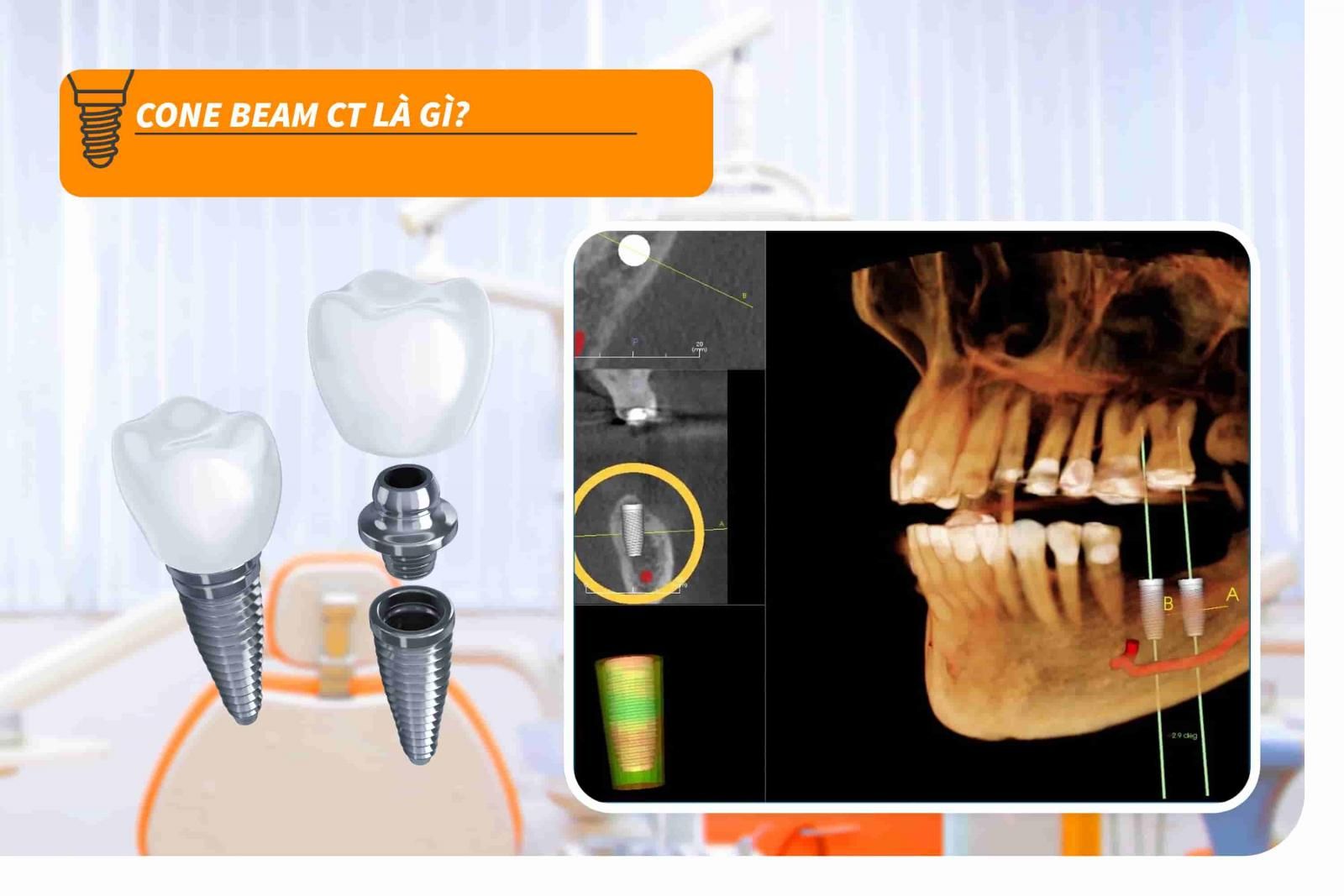 Cone Beam CT là gì?