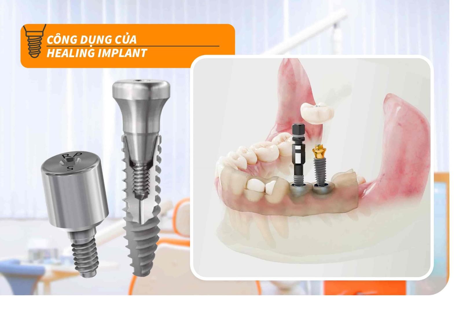 Công dụng của Healing Implant 