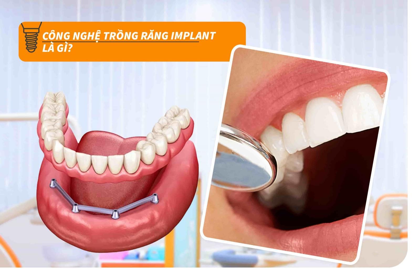 Công nghệ trồng răng Implant là gì?