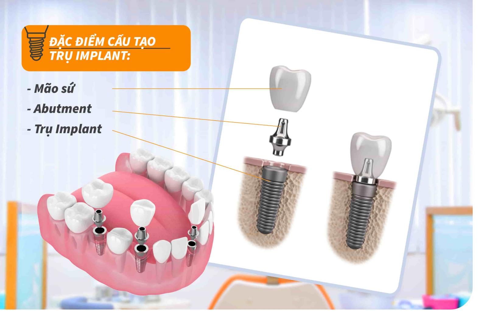 Cấu tạo của trụ Implant