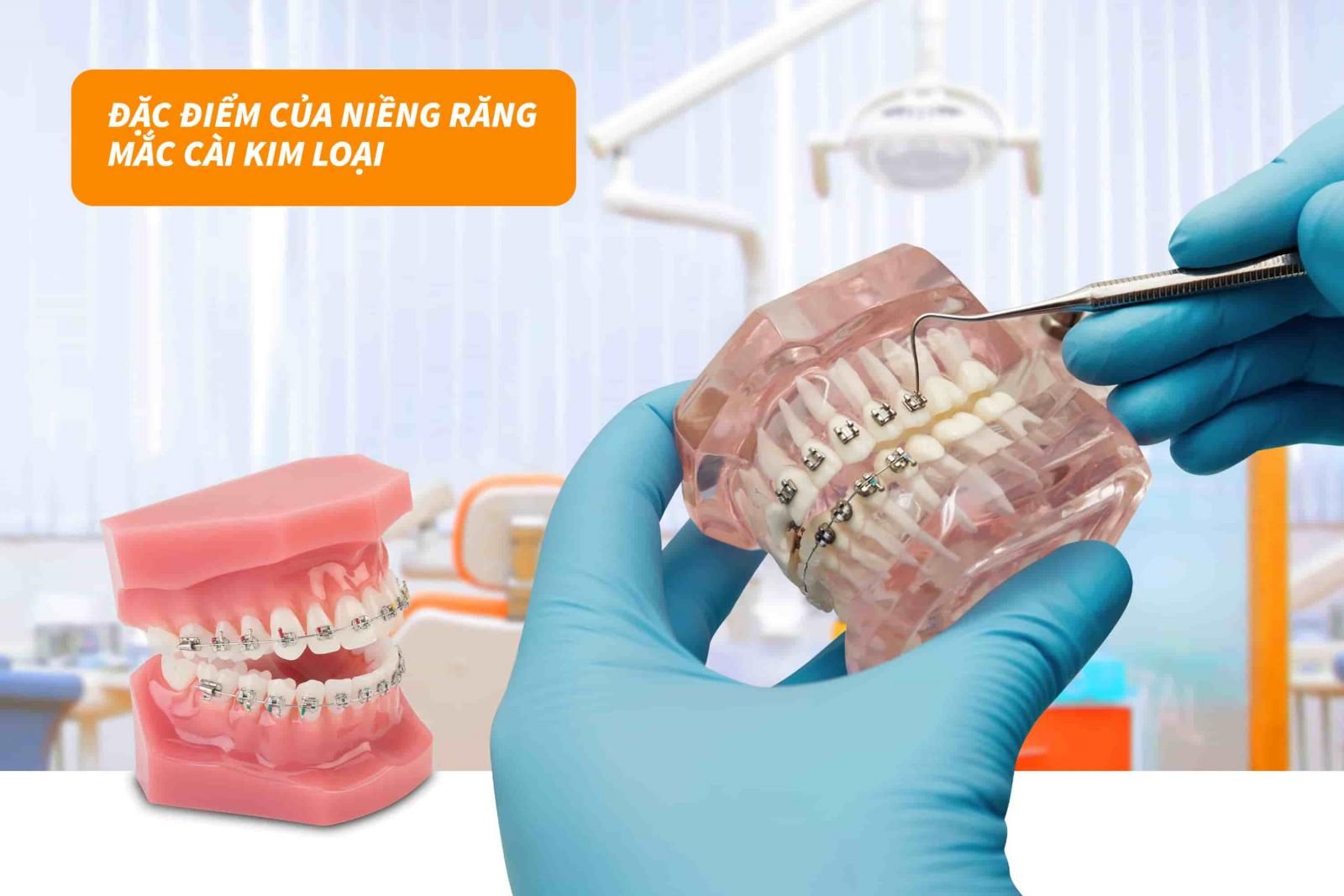 Đặc điểm của niềng răng mắc cài kim loại