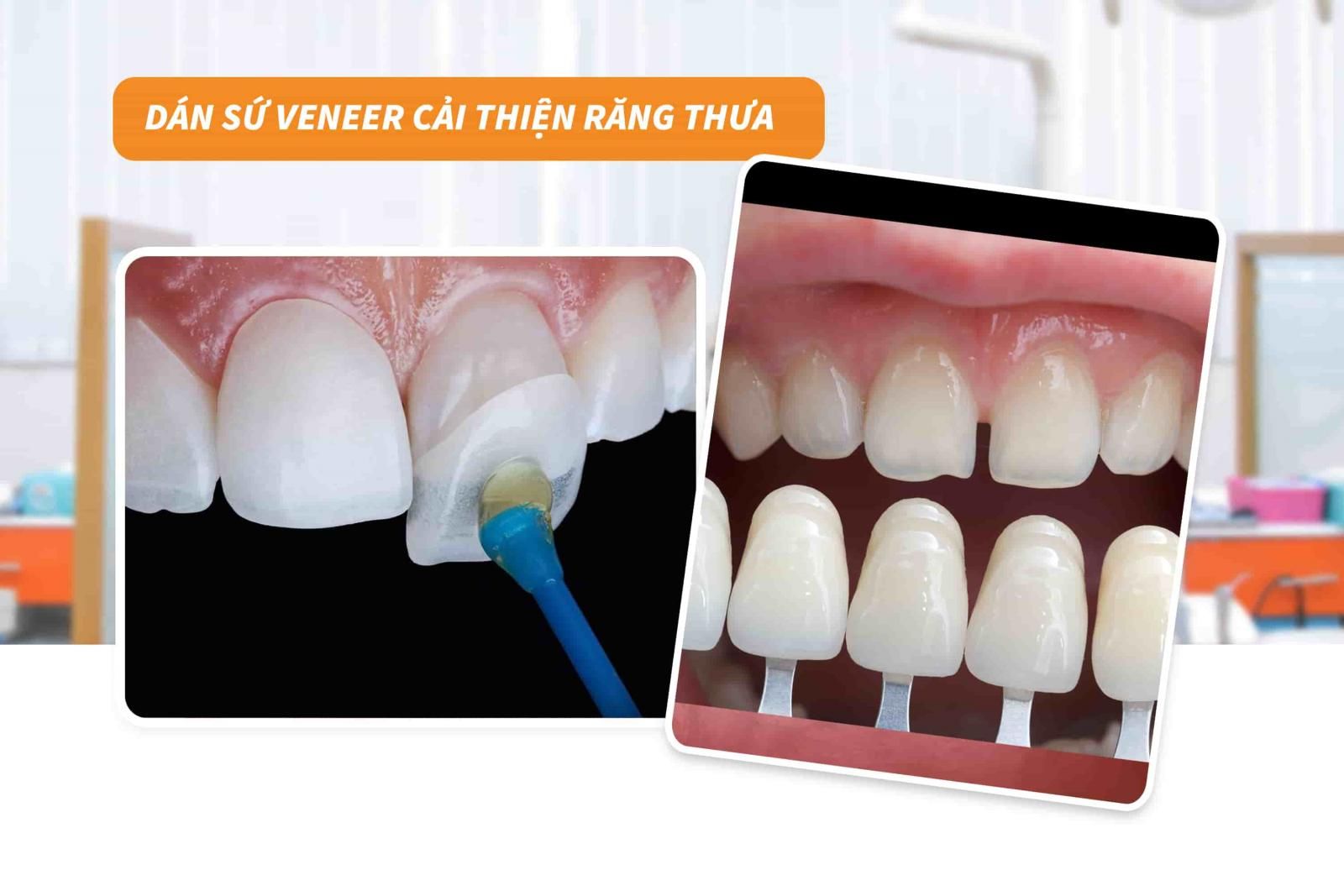 Dám veneer cải thiện răng thưa