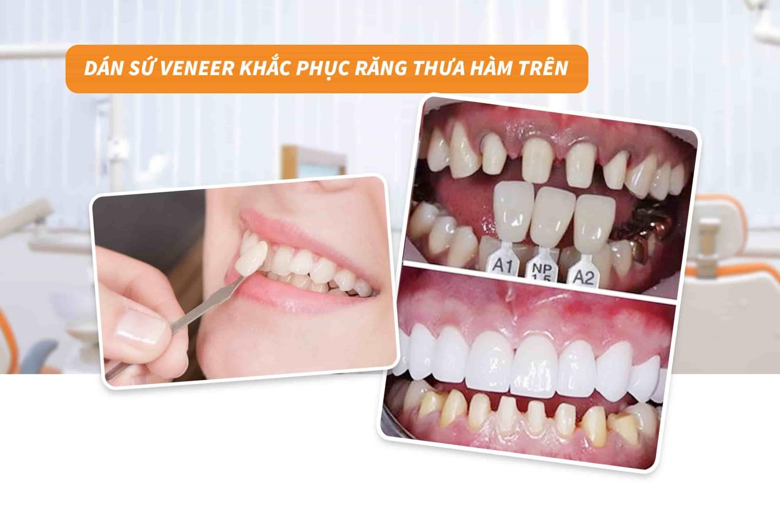 Dán sứ Veneer khắc phục răng thưa hàm trên