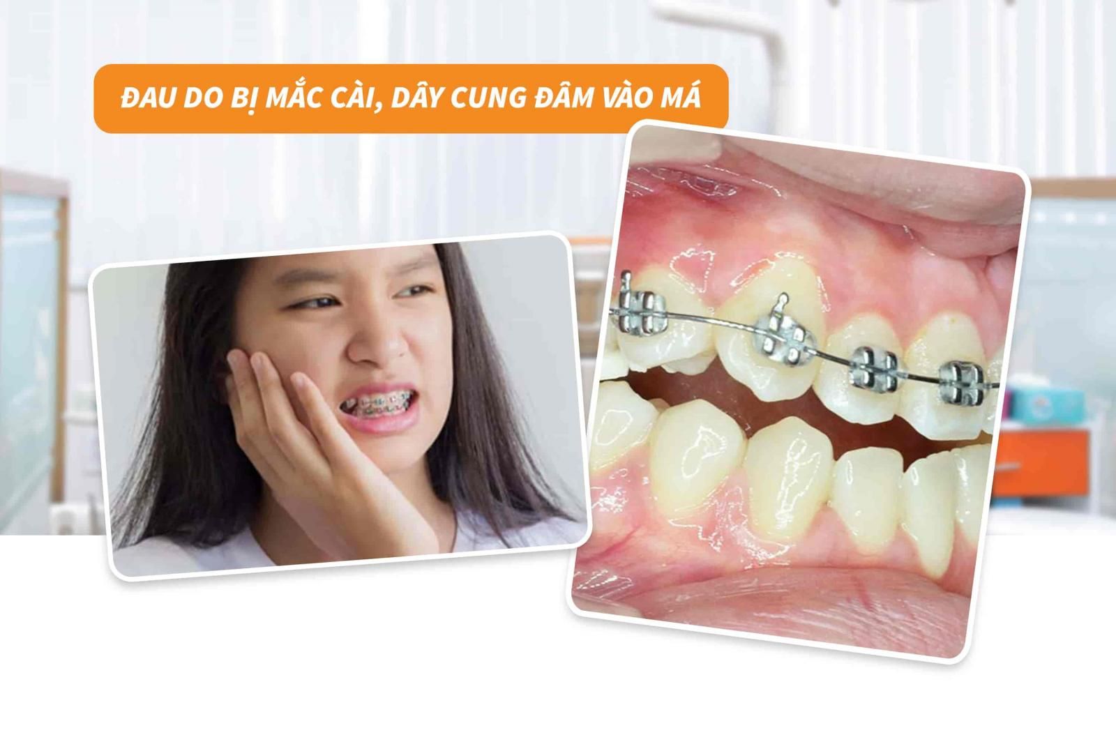 Đau khi mắc cài, dây cung đâm vào má