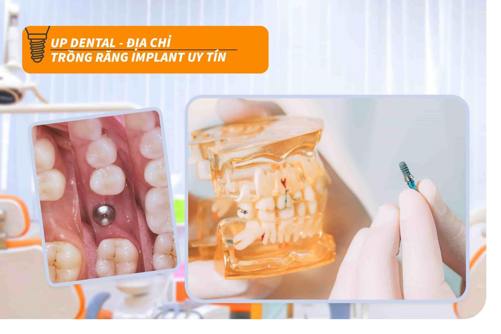 Địa chỉ trồng răng Implant uy tín