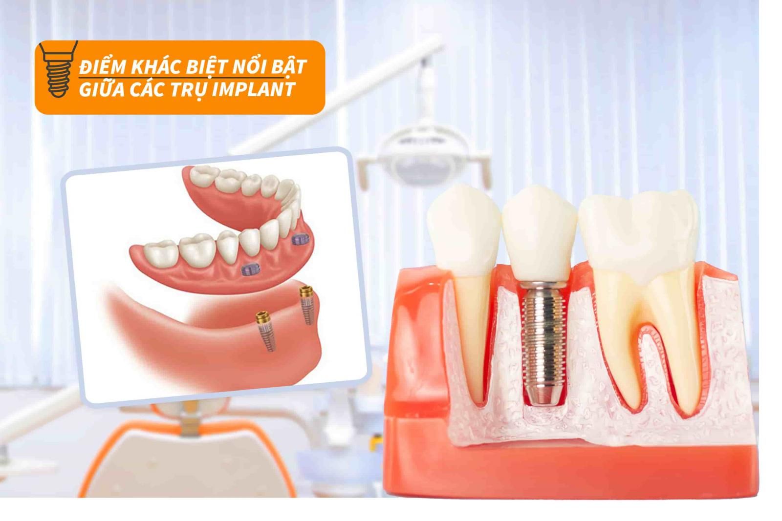 Điểm khác biệt nổi bật giữa các trụ Implant