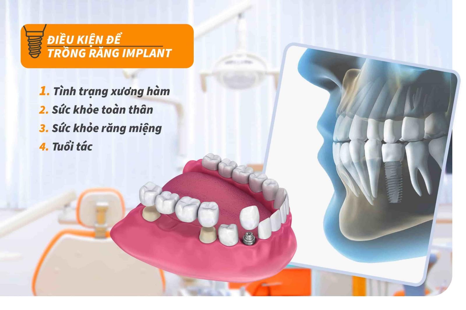 Điều kiện để trồng răng Implant