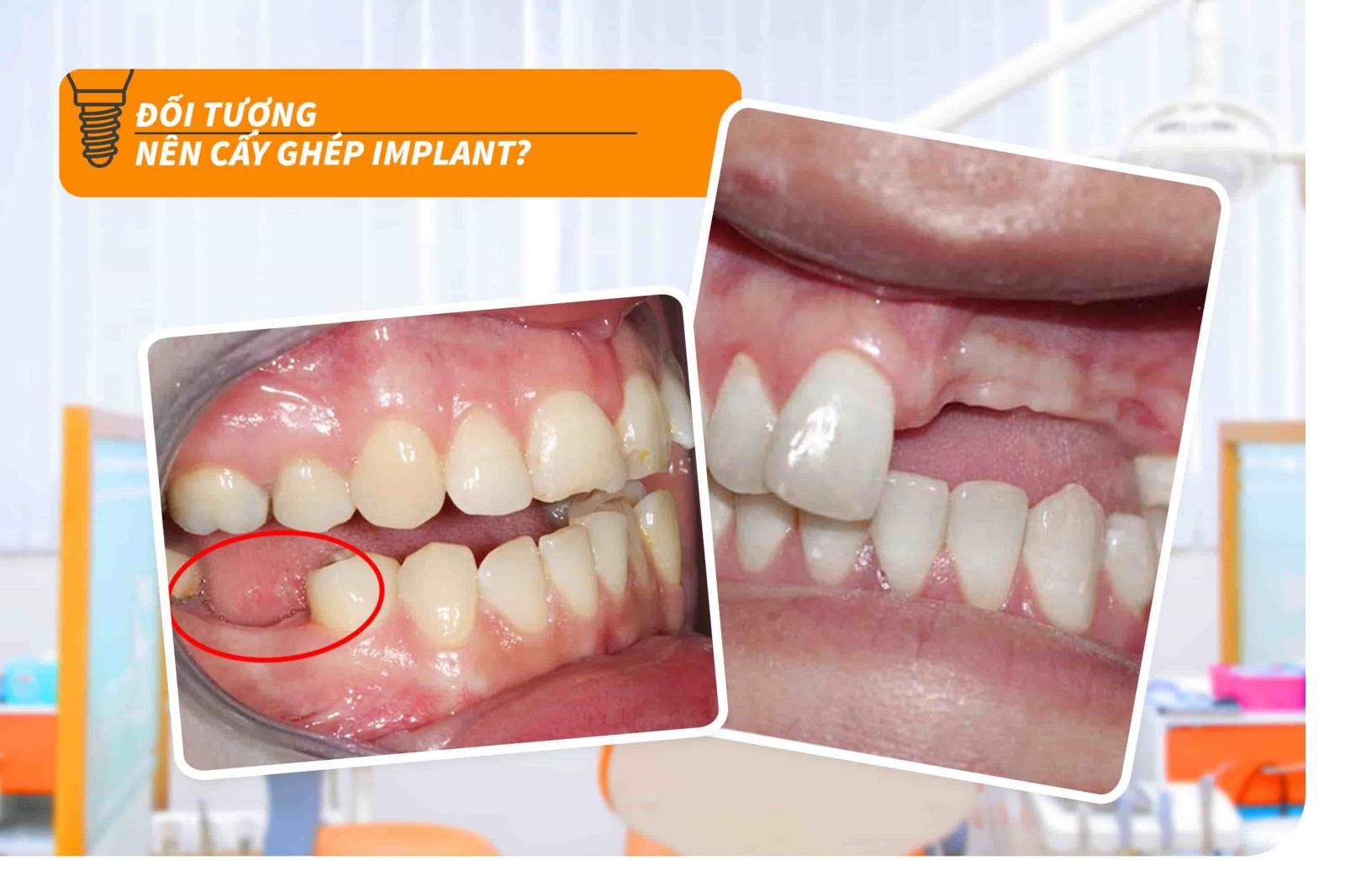 Đối tượng nên cấy ghép Implant