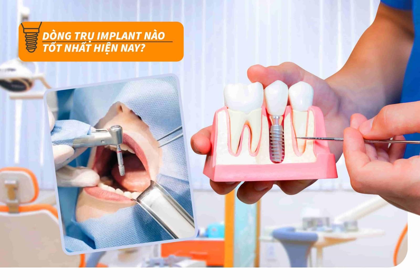 Dòng trụ Implant nào tốt nhất hiện nay