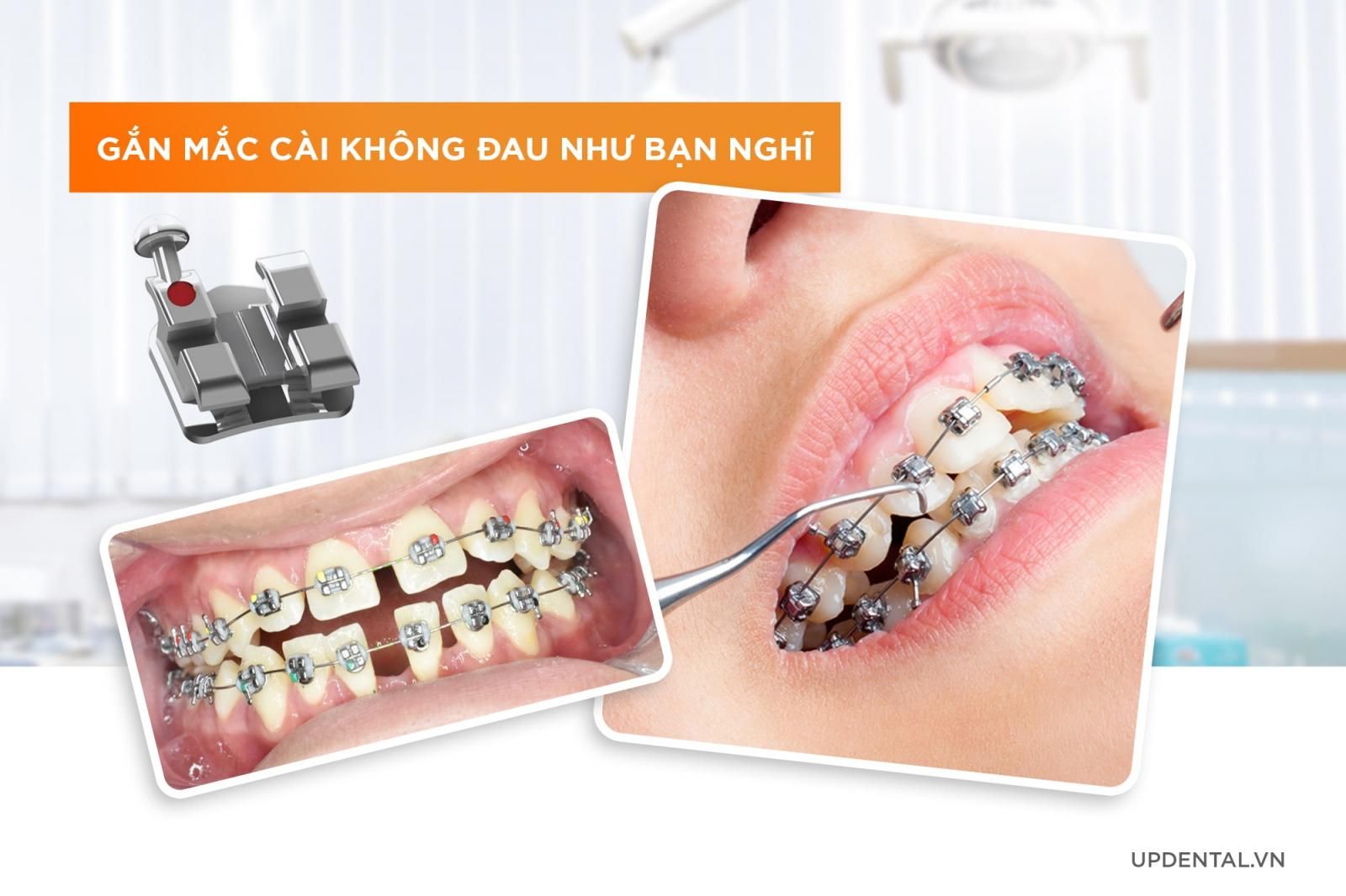 gắn mắc cài có đau không