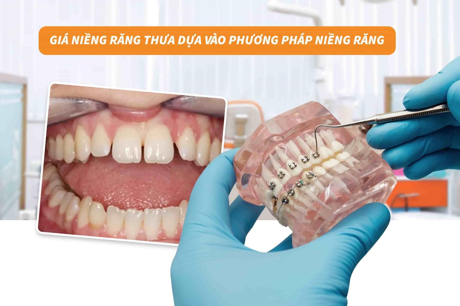 Giá niềng răng dựa vào phương pháp niềng