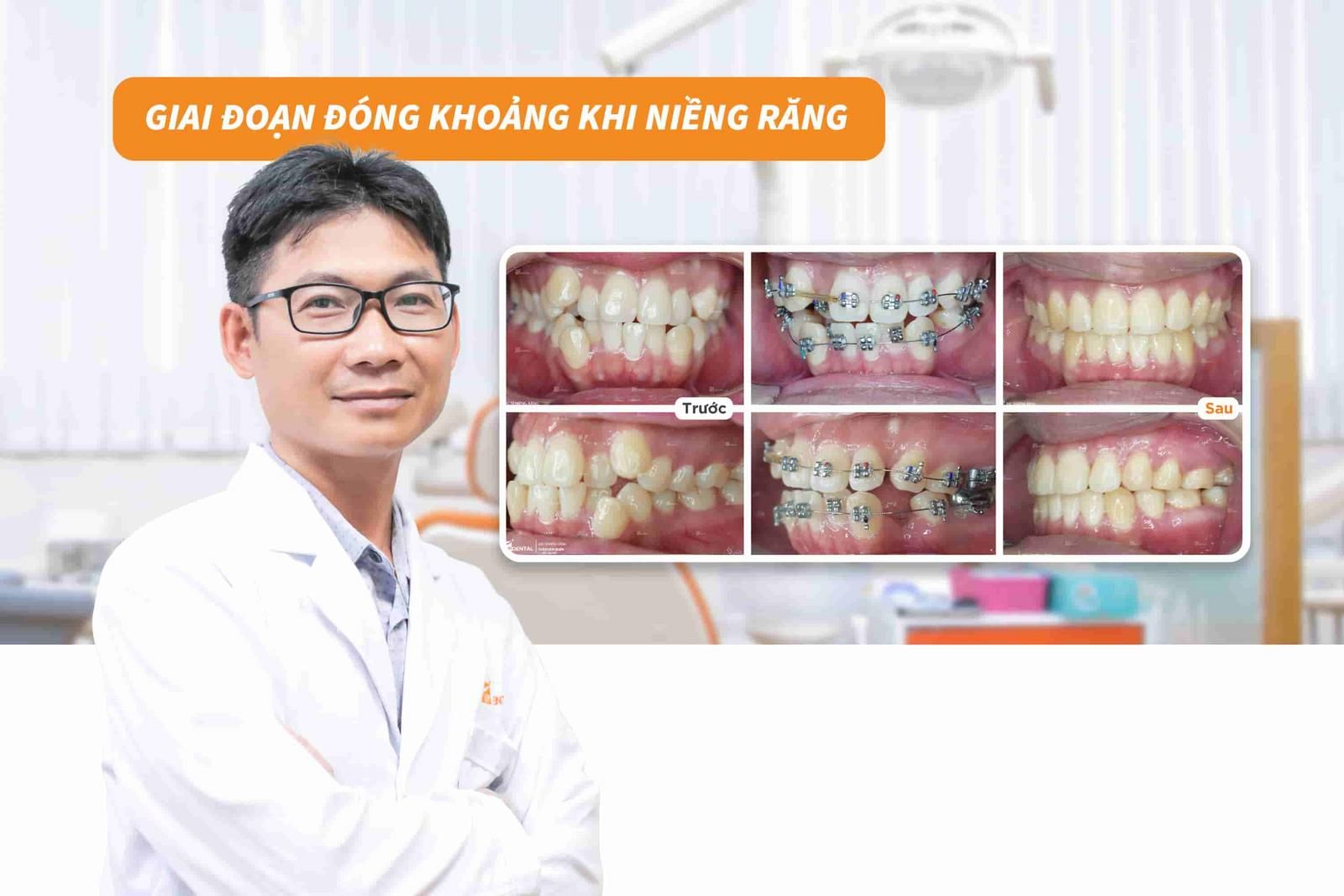 Giai đoạn đóng khoảng khi niềng răng