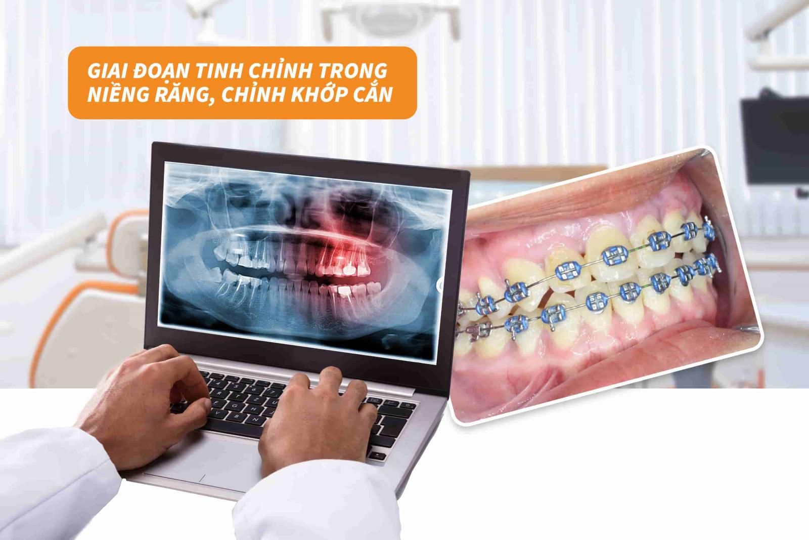 Giai đoạn tinh chỉnh trong niềng răng, khớp cắn