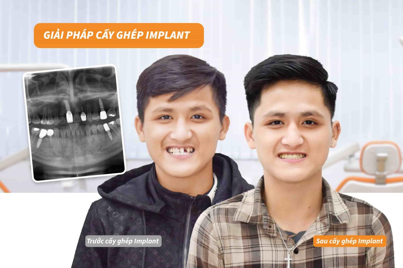 Cấy ghép implant phục hồi răng bị mất