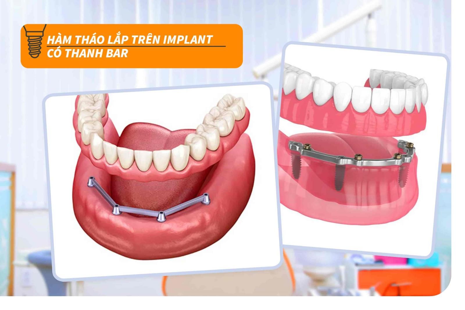 Hàm tháo lắp trên Implant có thanh bar