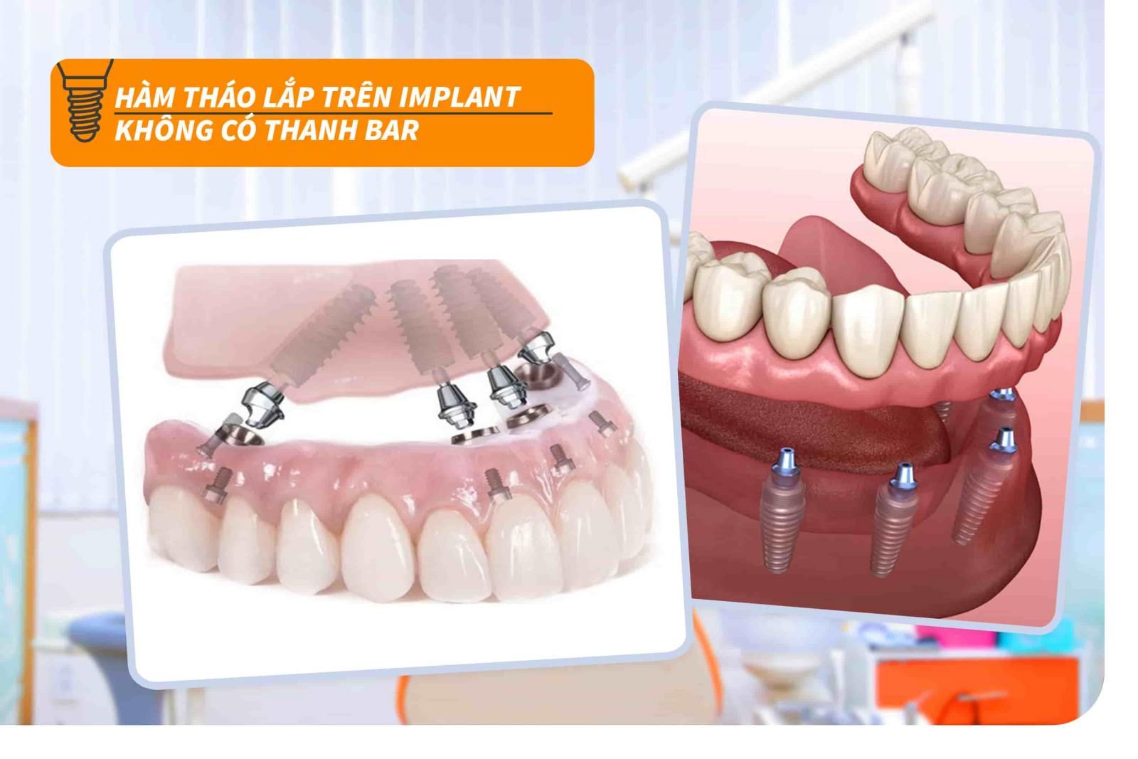 Hàm tháo lắp trên Implant không có thanh bar