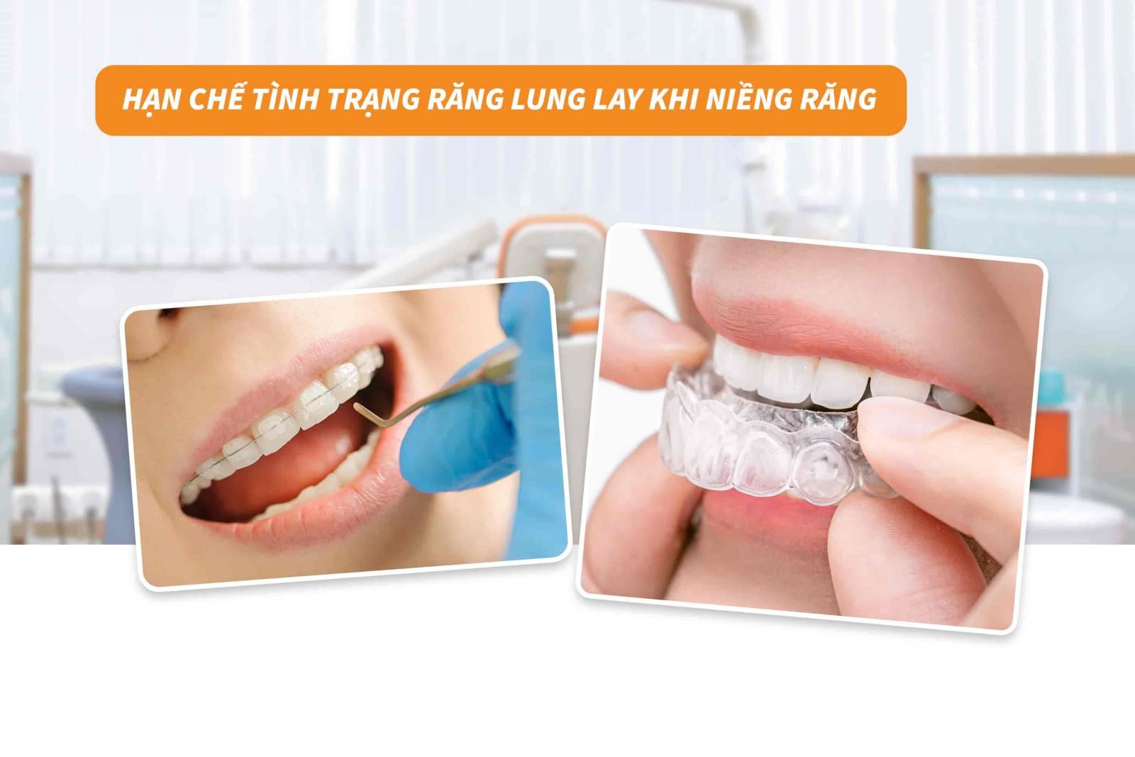 Hạn chế tình trạng răng lung lay khi niềng