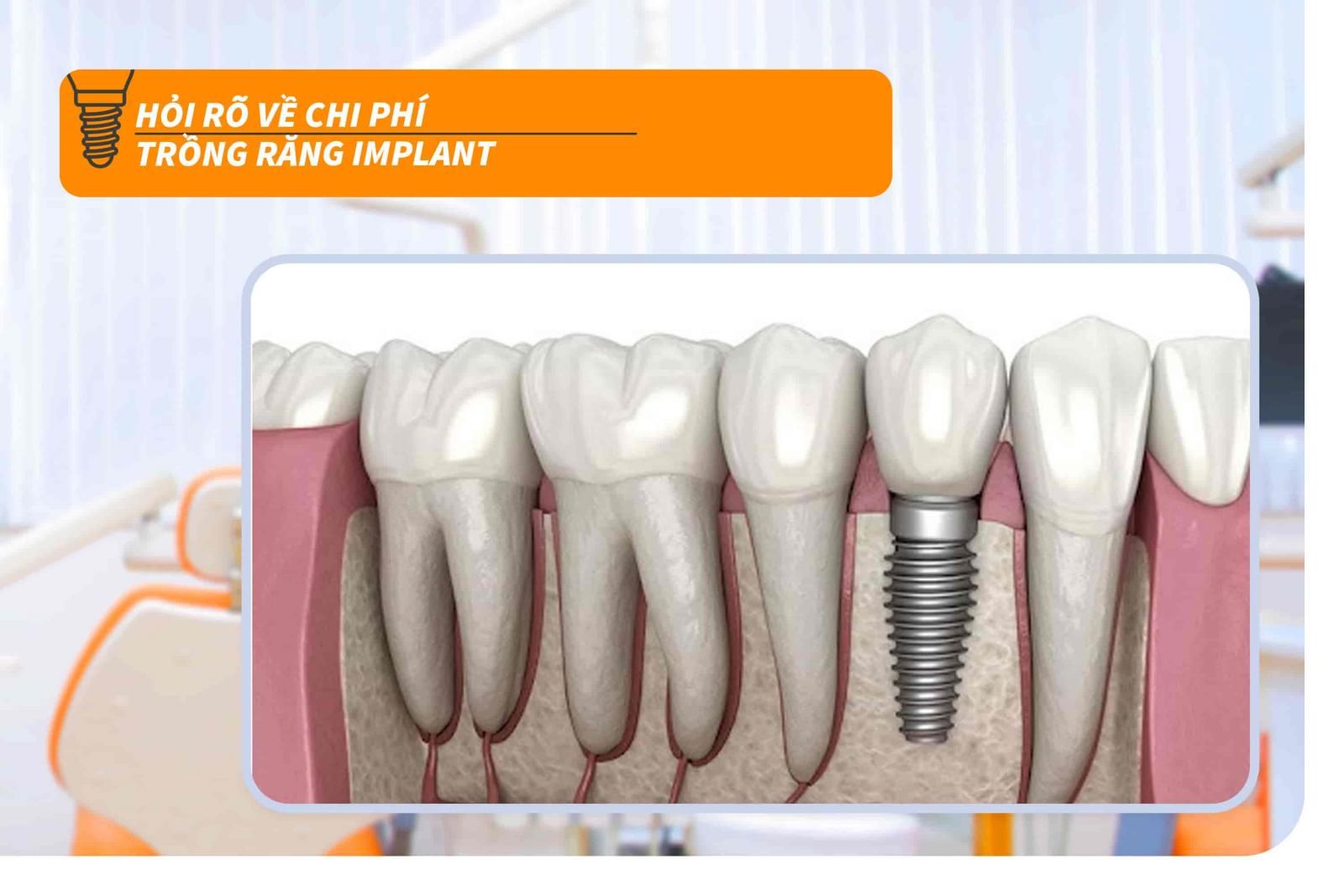 Hỏi rõ về chi phí trồng răng Implant