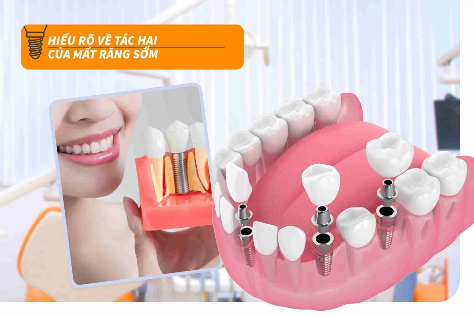 Hiểu rõ về tác hại của mất răng sớm