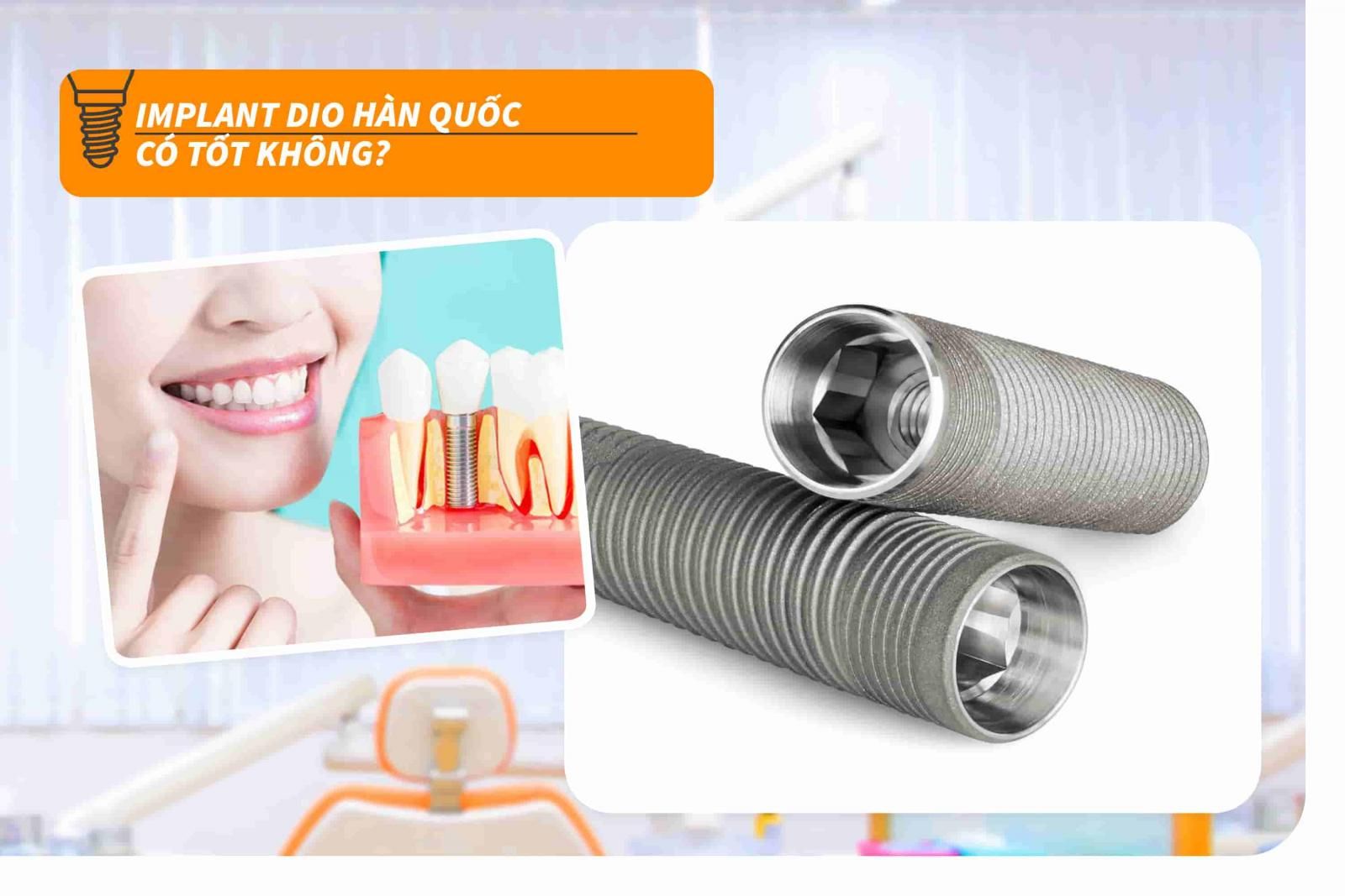 Implant Dio Hàn Quốc có tốt không?