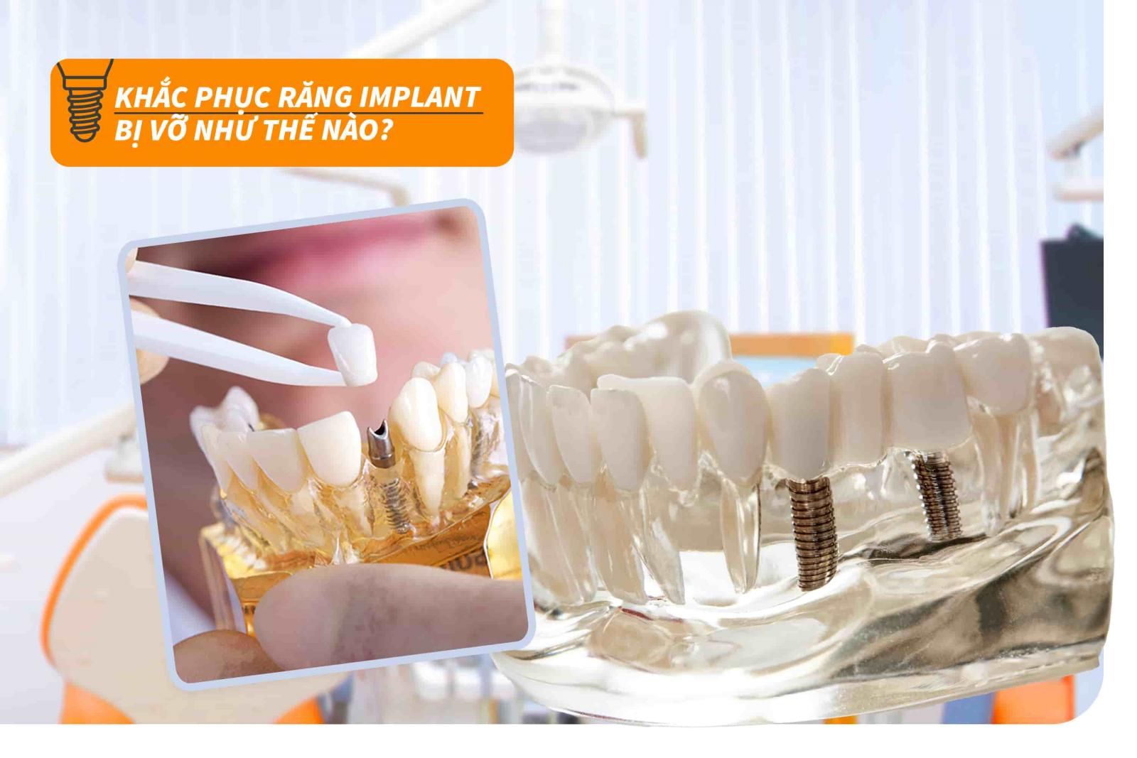 Khắc phục răng Implant bị vỡ như thế nào?