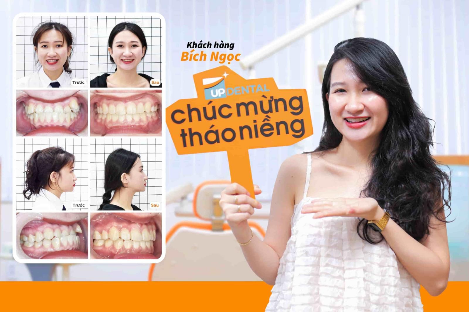 Hình ảnh niềng răng mắc cài kim loại của Khách hàng Bích Ngọc