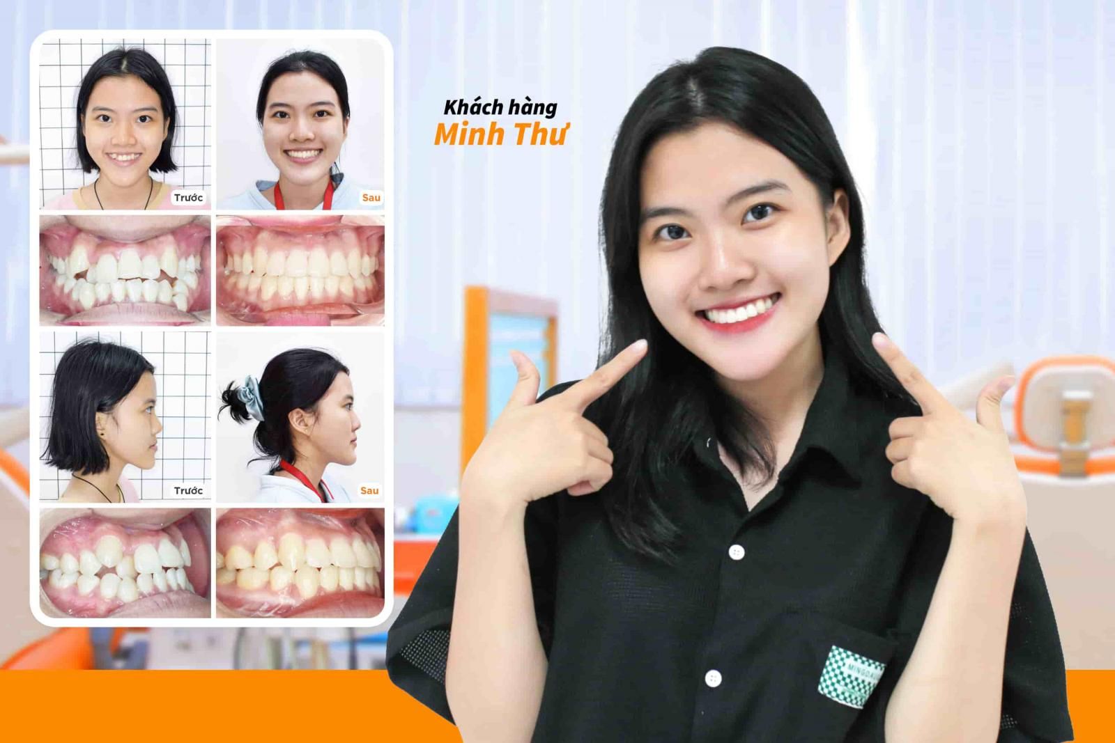 Hình ảnh niềng răng mắc cài kim loại của Khách hàng Minh Thư