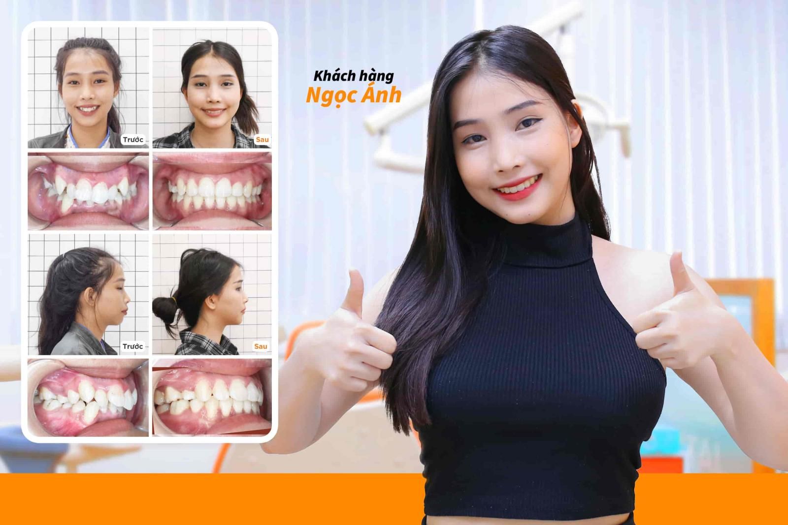 Hình ảnh niềng răng mắc cài kim loại của Khách hàng Ngọc Ánh