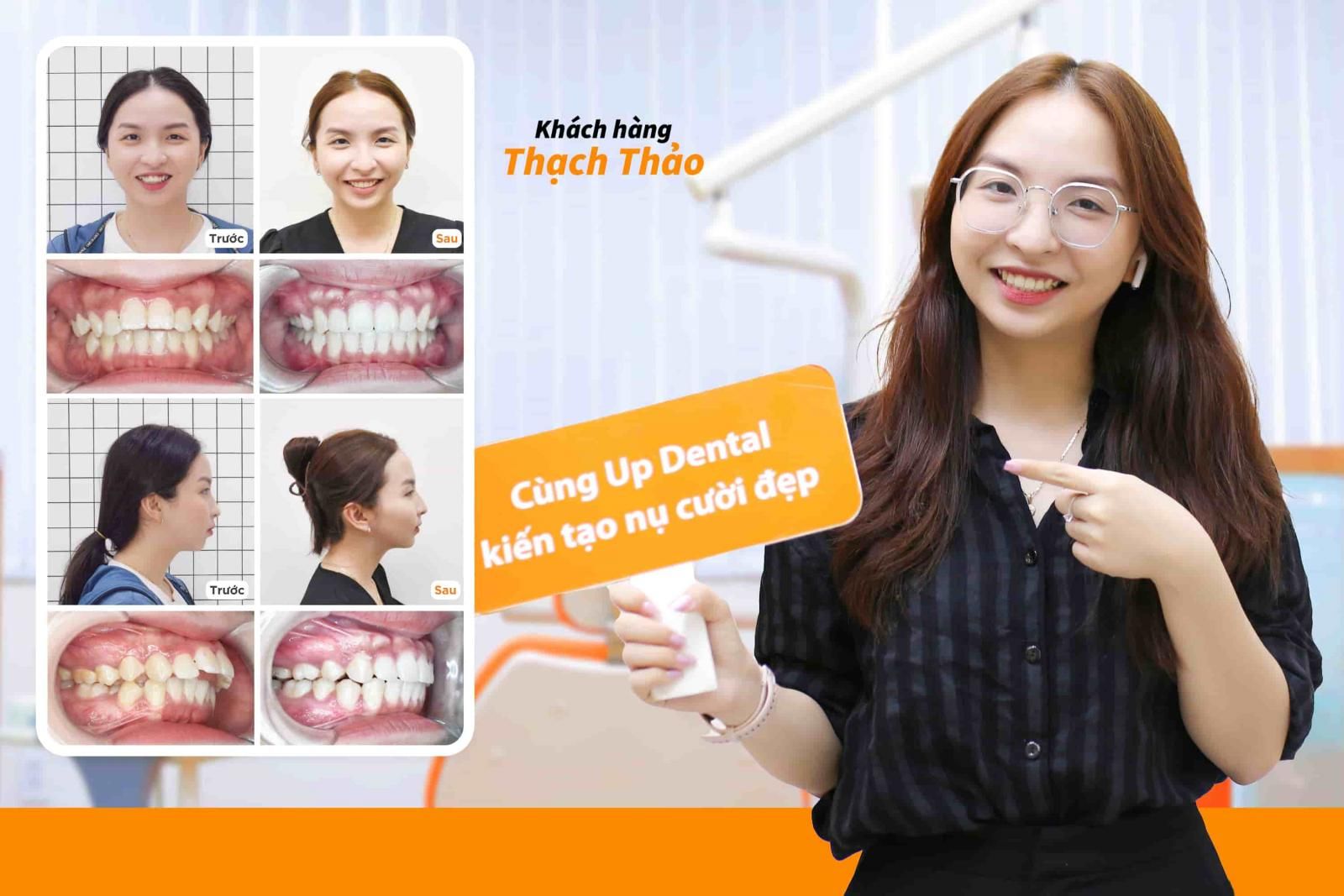 Hình ảnh niềng răng mắc cài kim loại của Khách hàng Thạch Thảo